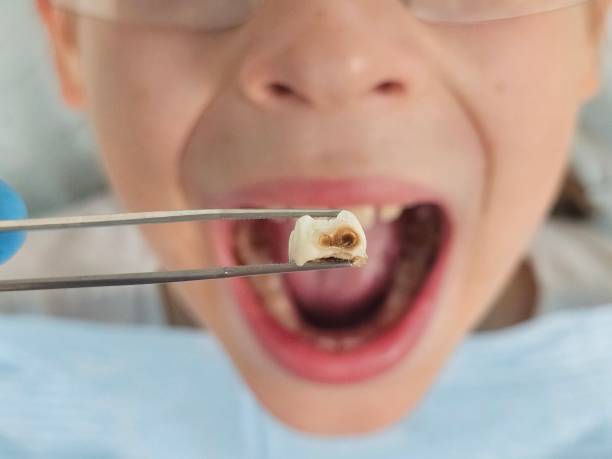 Best Emergency Wisdom Teeth Removal in Balcones Heights, TX